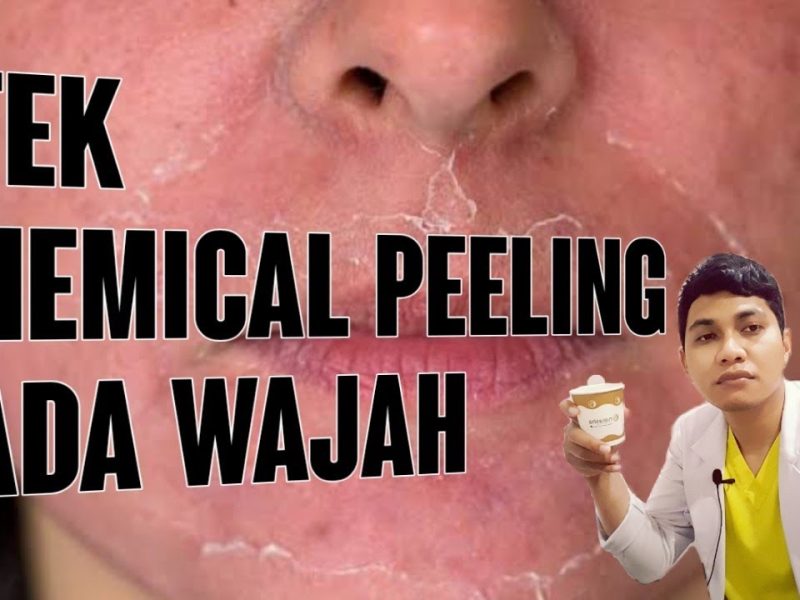 Proses Treatment Chemical Peeling