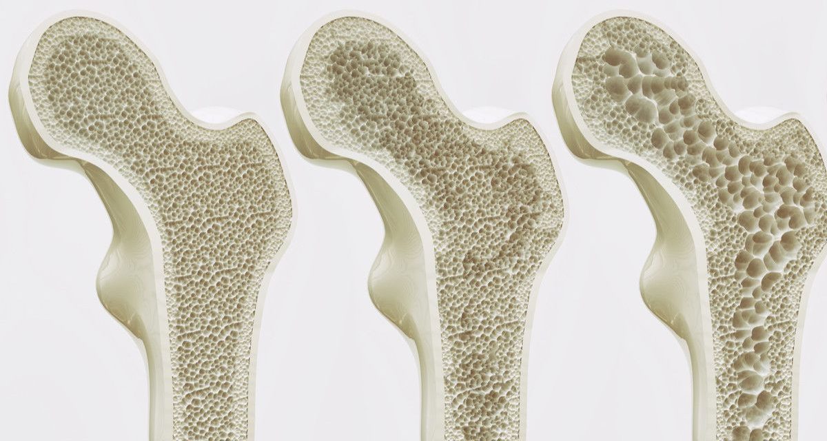 Penyakit Tulang Osteoporosis Dapat Terjadi Karena Pola Makan
