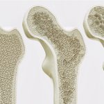 Penyakit Tulang Osteoporosis Dapat Terjadi Karena Pola Makan