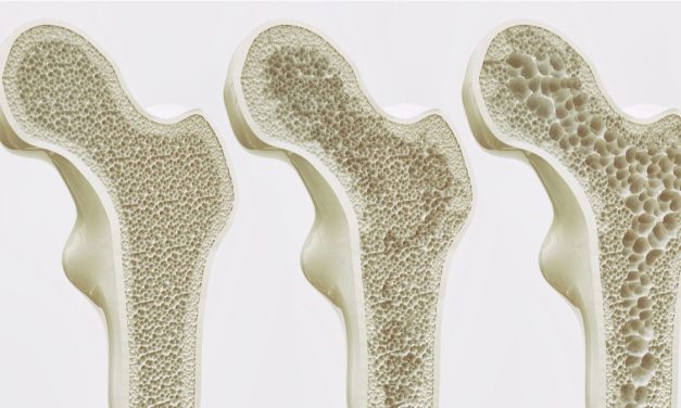 Penyakit Tulang Osteoporosis Dapat Terjadi Karena Pola Makan