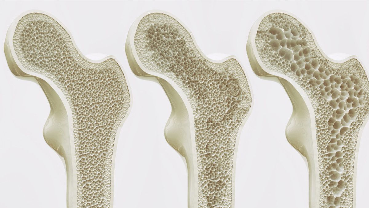 Penyakit Tulang Osteoporosis